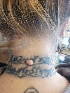 Cosmetic mole and skin tag removal on the neck at Skin Lab.