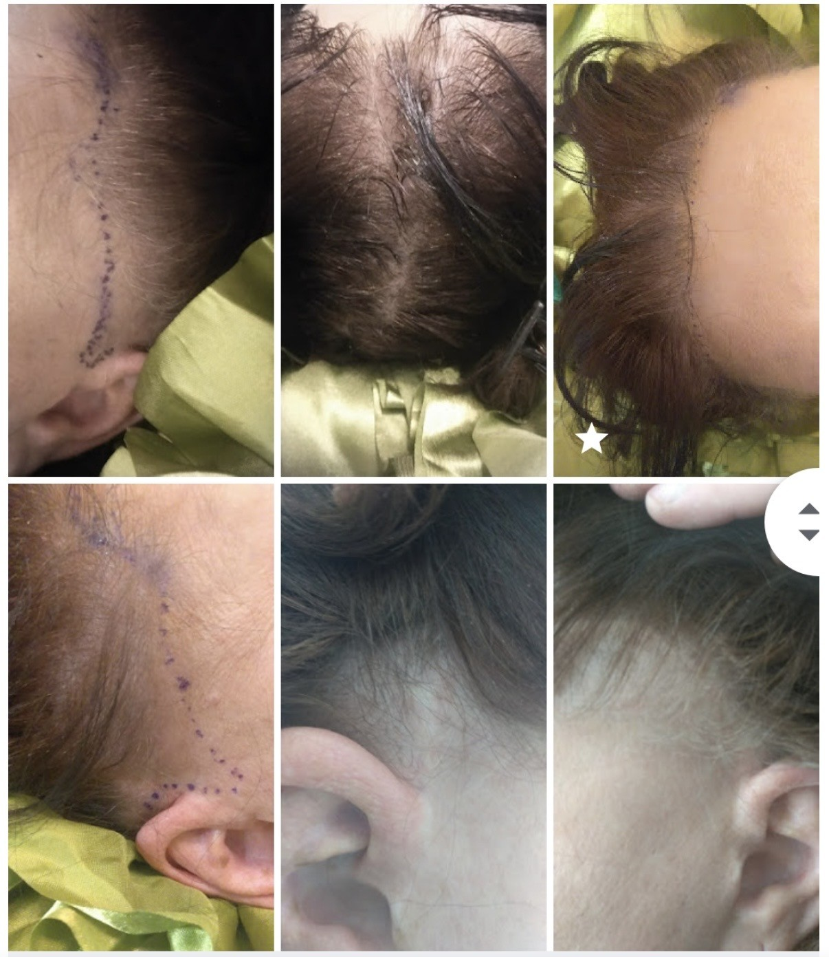 Scalp micropigmentation mapping and before/after — density restoration by Cristina.