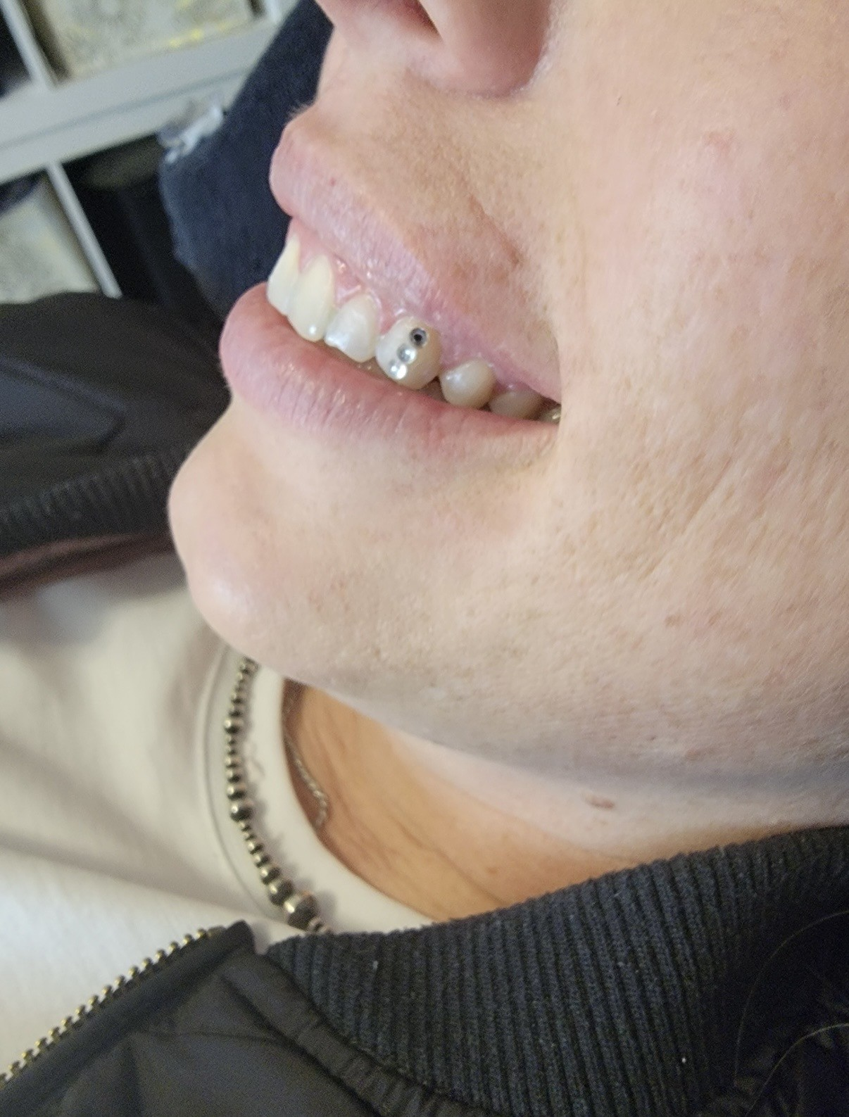 Tooth bling close-up — semi-permanent gem bonded to the tooth.