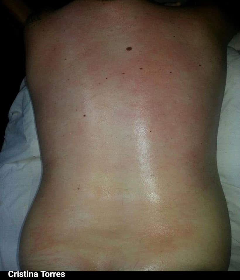 Same client's back immediately after Cirépil hard wax — clean and smooth.