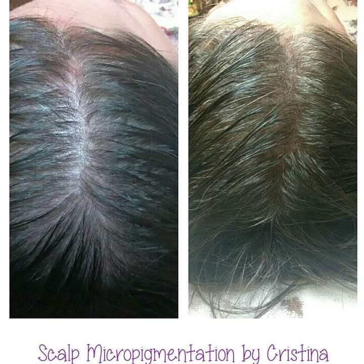 Scalp micropigmentation before and after — part-line density work.