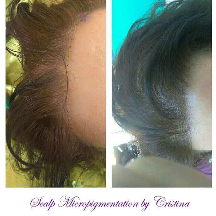 Scalp micropigmentation before and after — hairline density restoration by Cristina.