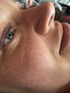Glowing, freckled skin after a Skin Lab facial.